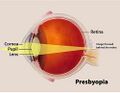 658 presbyopia.jpg