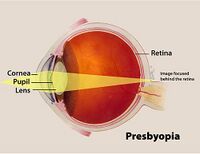 658 presbyopia.jpg