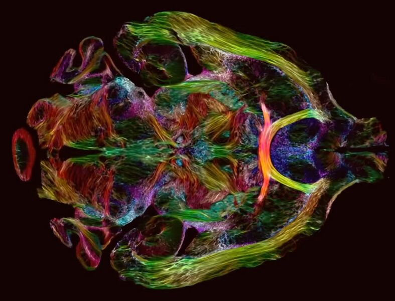 File:928 MRI Brain.jpg